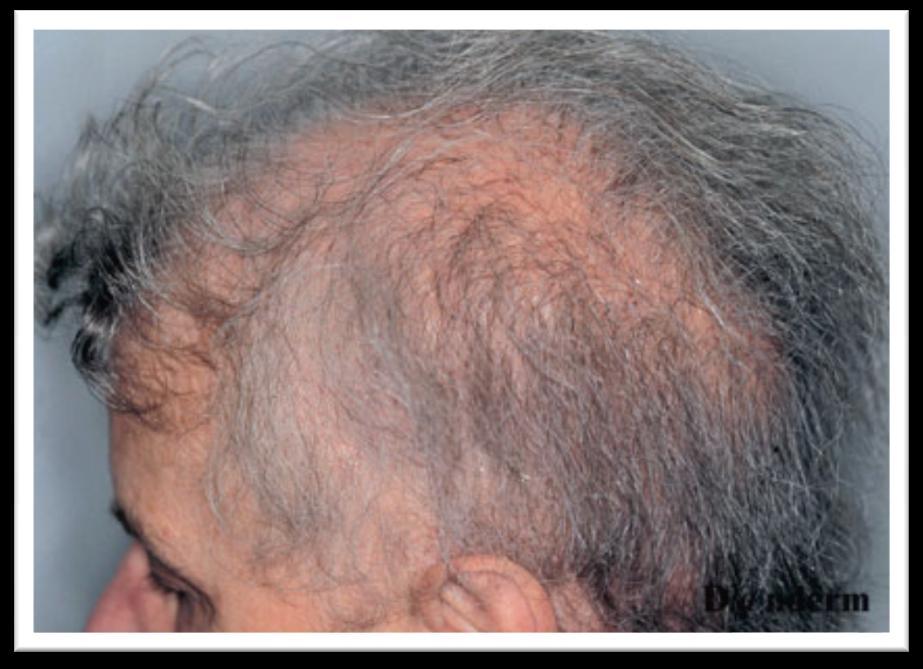 Hair Loss Caused By Lichen Planus There are several factors that can result in hair loss. One common disease is a disorder known as lichen planus.