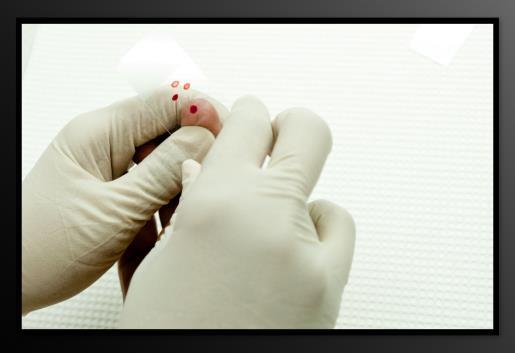 Collecting Blood Sample for Thin Prep: Collecting Blood Sample for Thin Prep Working quickly, handling slides by the edges, collect the blood using the following