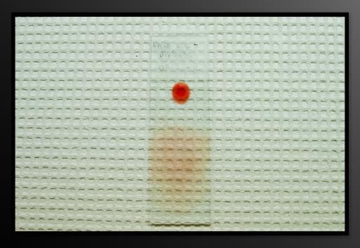 Making a Thick Film: Making a Thick Film Using the corner of the spreader, quickly join the drops of blood and spread them to make an even, thick film.