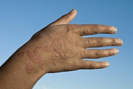 [Allergic reaction on a man's hand. J.