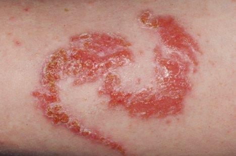 [Allergic reaction on a 14-year-old girl. Dr. P. Marazzi / Photo Researchers] PPD and some other hair dye ingredients may cause reactions in some individuals.