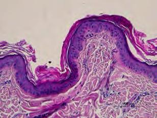 (SC) thin epidermis with straight horizontal basal membrane no dermal