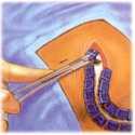 other delicate procedures. The tip on the CODMAN Microsurgical Marker is slightly flexible.
