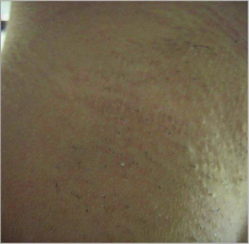 2 Second-generation devices for unwanted hair removal based on high-intensity pulsed flashes of multi-chromatic light (intense pulsed light, IPL) are equipped with closed-loop cooling
