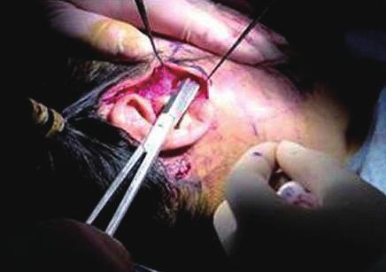 After complete subperiosteal dissection and vertical lifting of the midfacial flap, multiple suspension sutures were anchored to the deep temporal fascia.