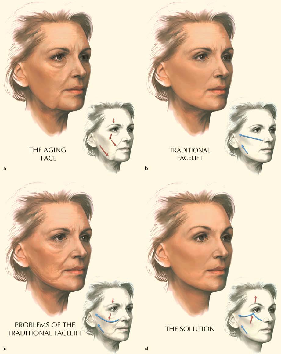 42 Composite Facelift 291 Fig. 42.11. a The aging face. Arrows demonstrate the normal gravitational direction of aging. b Traditional facelift.