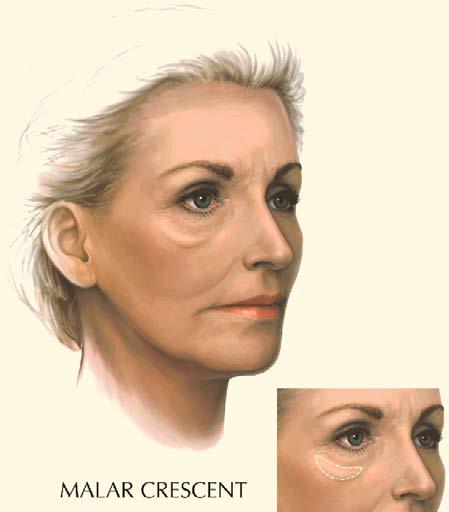 292 Fig. 42.12. Malar crescent. This crescent-shaped fullness corresponds to the lower eyelid muscle (orbicularis muscle) and occurs along the upper cheek area.