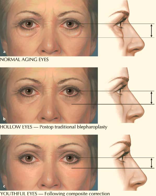 traditional facelift. (Courtesy of S. Hamra, Dallas) Fig. 42.13. a Normal aging eyes. Contours have become wider and deeper. b Hollow eyes.