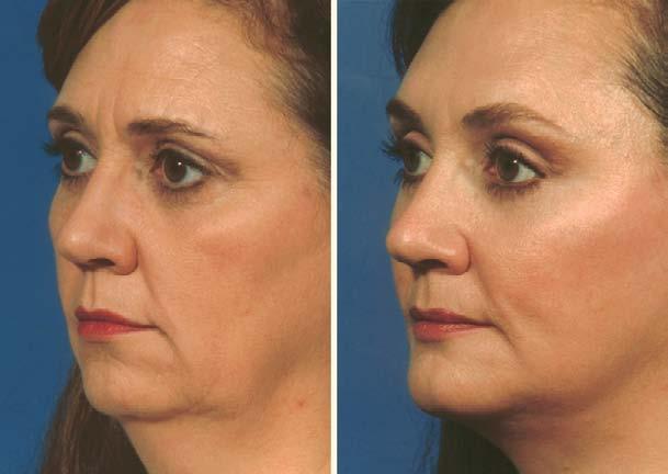 composite facelift and arcus release.