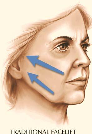 42 Composite Facelift 283 Fig. 42.1. Traditional facelift. The direction of lift in the traditional facelift is singular and lateral toward the ear. This is the only direction of pull. (Courtesy of S.