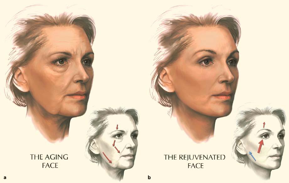 42 Composite Facelift 285 Fig. 42.5. a The aging face. Arrows demonstrate the normal gravitational direction of aging.