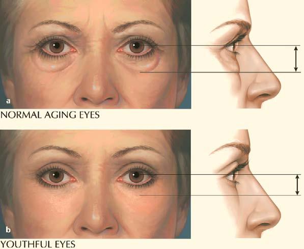 The arrows demonstrate the two-direction lift of the composite facelift (Courtesy of S. Hamra, Dallas) Fig. 42.6.