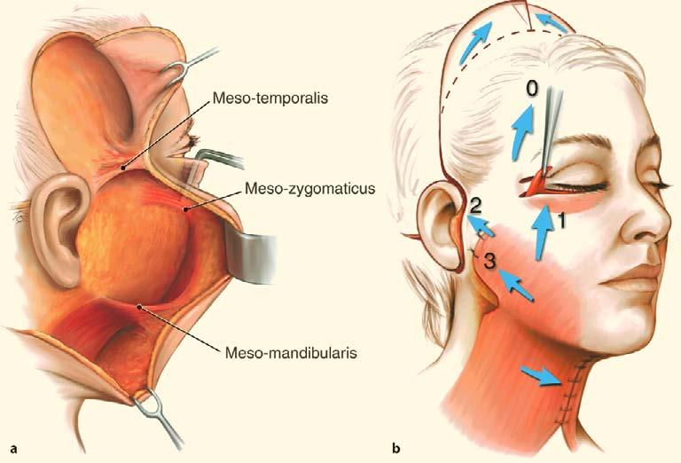 286 Fig. 42.7. a The three mesenteries are created during the composite facelift dissection. The meso-temporalis contains the branches of the frontal nerve.