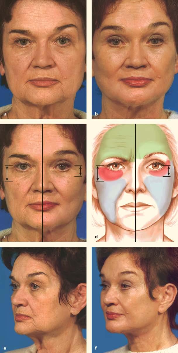 288 Fig. 42.9. a Preoperative patient with a negative lower-eyelid vector with typical signs of aging.