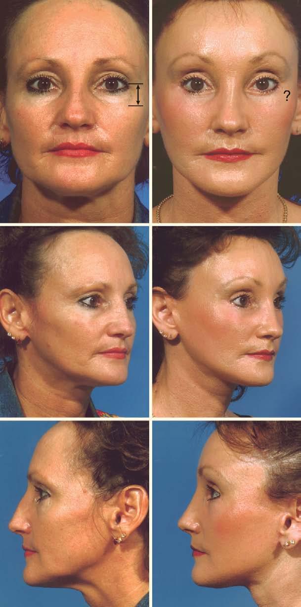 42 Composite Facelift 289 Fig. 42.10. A preoperative view of a 44-year-old with normal signs of aging.
