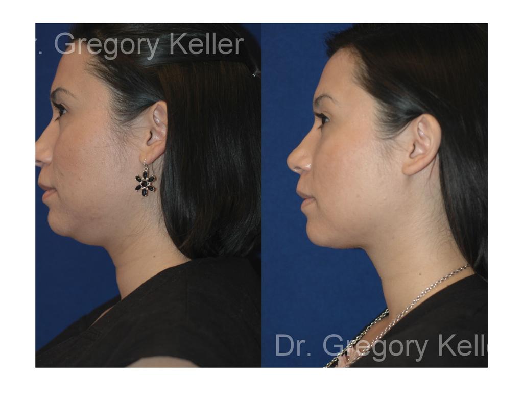Minimally invasive web neck lift muscle (a muscle used to open the mouth).