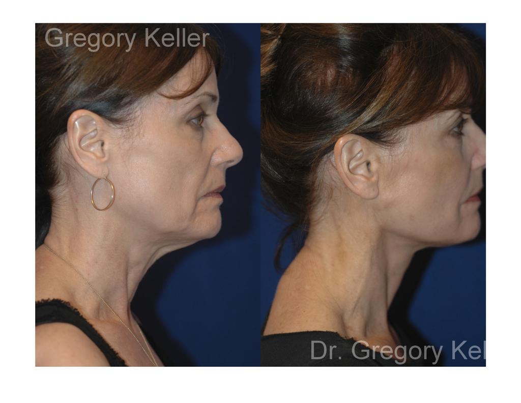 Web neck lift performed behind her ear and into the hairline fo remove the