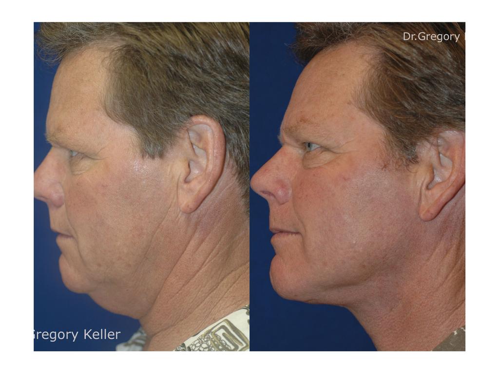 Webneck lift with posterior muscle pull facelift.