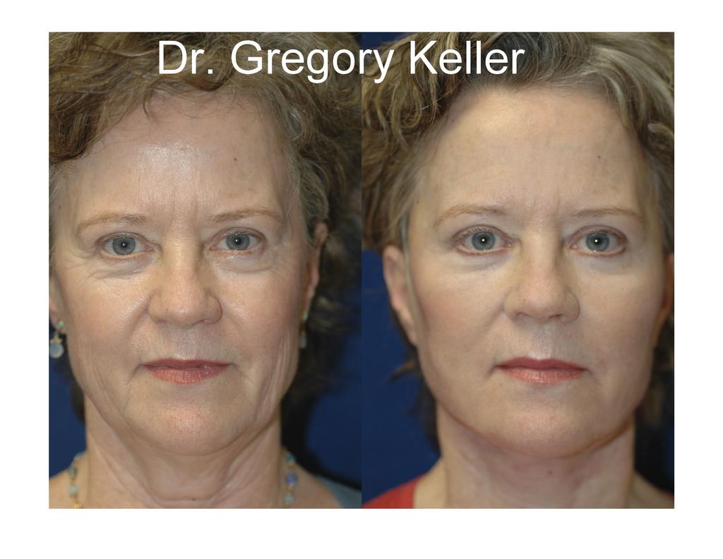 Facial rejuvenation and