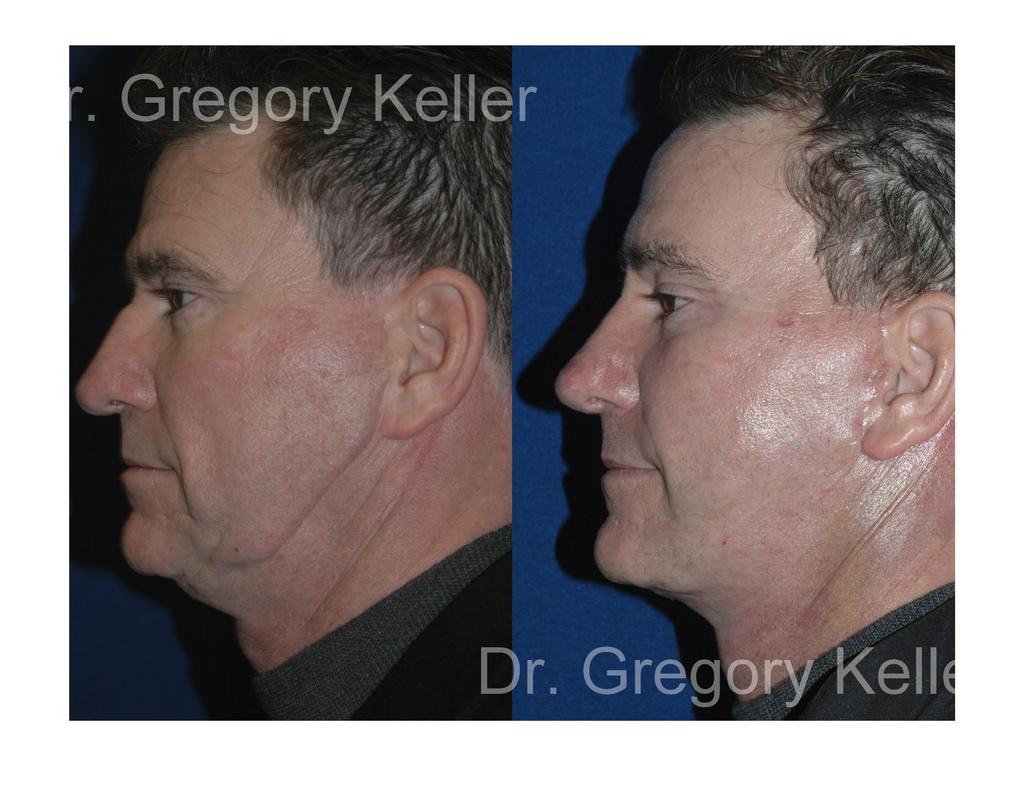 Rhinoplasty and facial rejuvenation the nasal angles gave a "cleaner " and more