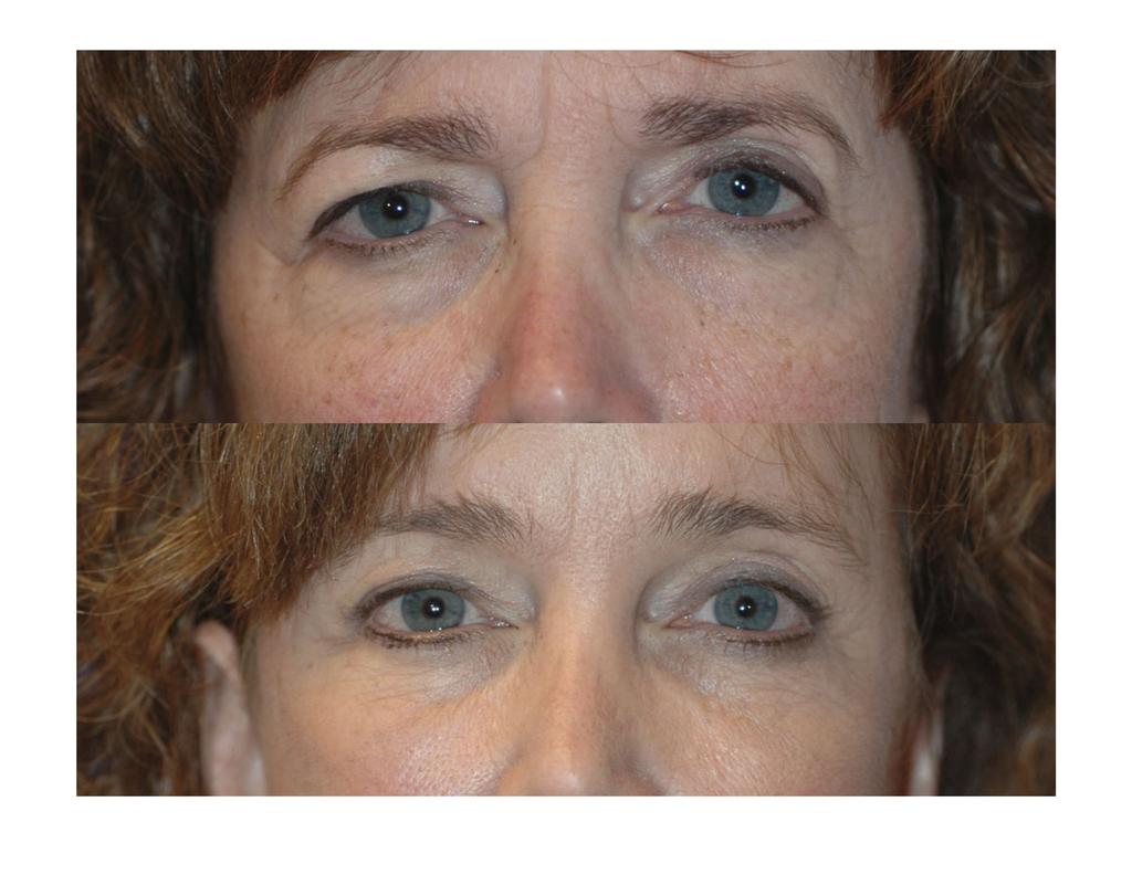Upper and lower blepharoplasty and facelift into the cheek. Dr.