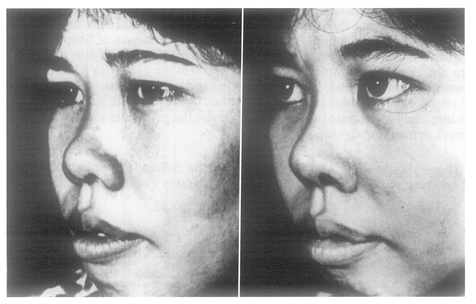 cosmetic surgery operations (Table III). A FIG. 3 B A FIG. 4 B Photographs taken before and after augmentation rhinoplasty.