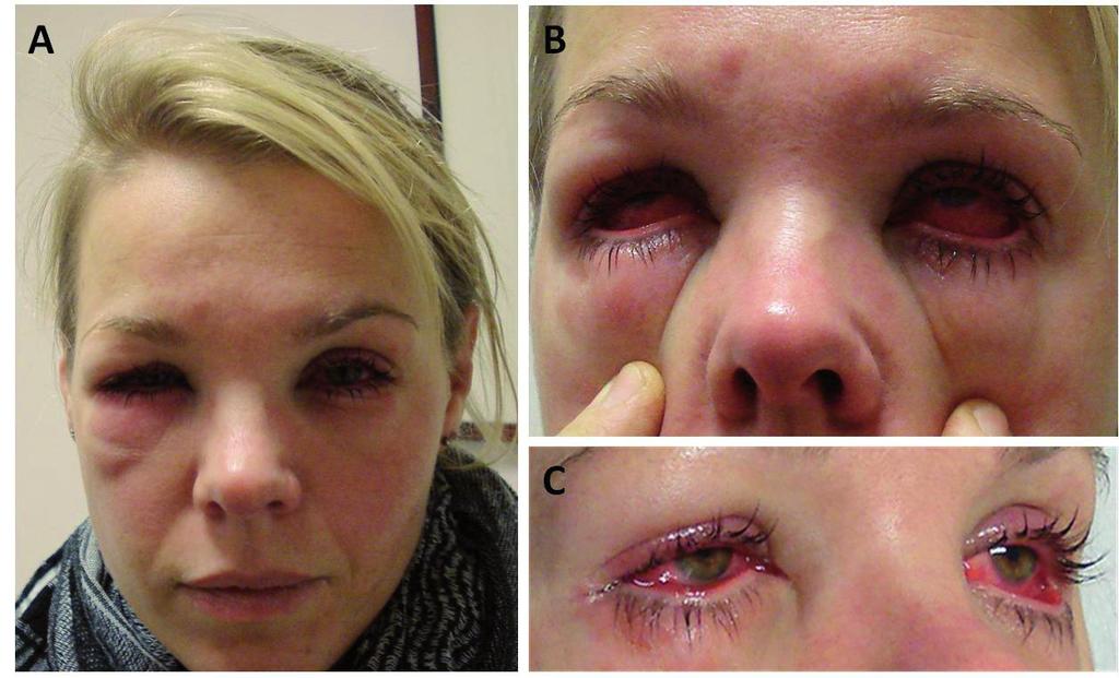 8. Blepharoconjunctivitis caused by PPD Introduction p-phenylenediamine (PPD) is a hapten with an extreme sensitizing potency.