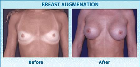 Breast The elevate breast Lift the lift sagging procedure breast. removes some skin and a little breast tissue to Breast When Mammoplasty making achieved.