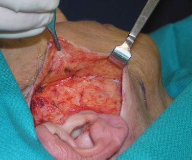 Materials and Methods One-thousand patients received short-scar rhytidectomy by the senior author (WHL) between December 2002 and January 2005.