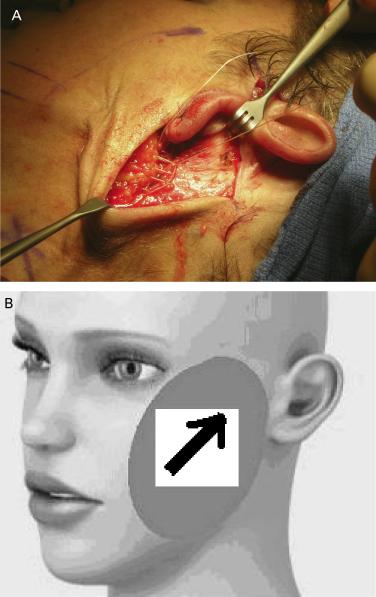 REVIEW OF 1,000 CONSECUTIVE SHORT-SCAR RHYTIDECTOMIES Figure 3. SMAS plication with running double layered locking suture technique (A).