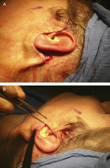As incisions in this series remain in the postauricular sulcus, it becomes necessary to accept moderate bunching of skin edges behind the ear for the early to midpostoperative period (B).