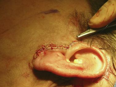 TANNA AND LINDSEY sloughing was noted. Skin tethering, reported to sometimes occur after liposuction, was not observed. Figure 5. Tension-free closure of short-scar rhytidectomy.