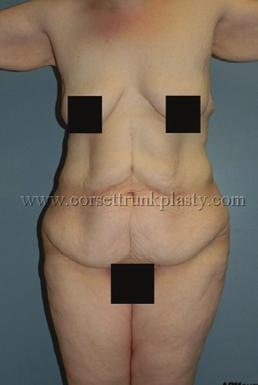 thighplasties) resulting in 9½-lb skin resection.