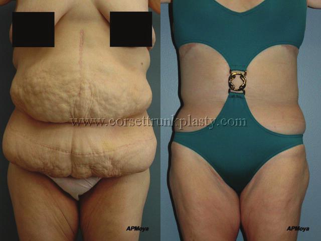Introduction The Corset Body Lift is an alternative approach to MWL body contouring which can be successfully utilized in a large number of patients.