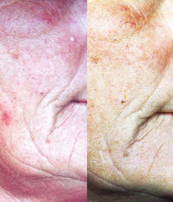 Vitamin A over the years 1930 Scientists first suggest that aging skin is caused by a vitamin A