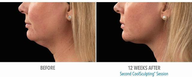 Our special introductory prices on CoolSculpting continue through October, so get a head start on
