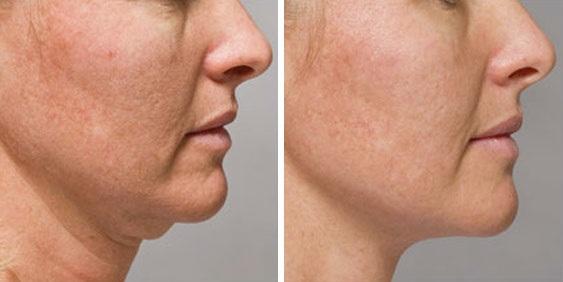KYBELLA is the FDA-approved injectable treatment especially designed for eliminating fullness under