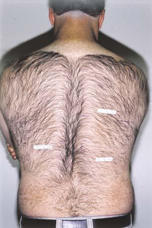 A clinically apparent reduction of hair regrowth still can be observed for all three test sites, with test site 3 demonstrating the strongest reduction.