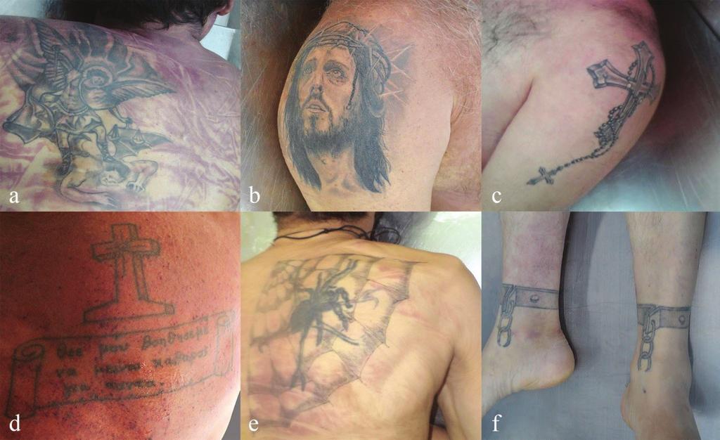 Katsos K. et al. Tattoos and abuse of psychoactive substances in an autopsy population sample from Greece of death could not be determined due to the advanced state of decomposition of the decedent.