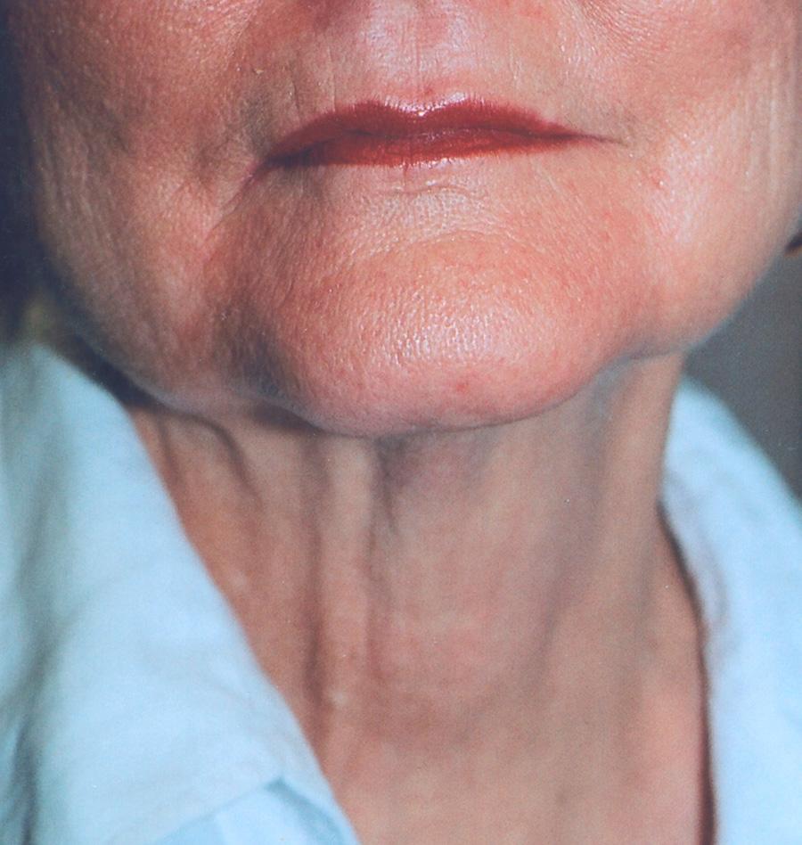 Before 1 Treatment area, but omitted the uppermo row of pulses on the face and the lowe row on the neck.