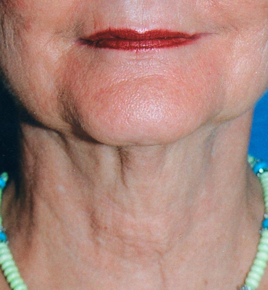 lines on the neck during the second treatment.