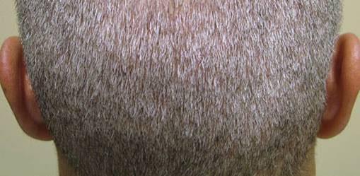 Since the hair follicles extend just under the skin, there is literally no way to obtain the follicles from the donor area without incising the skin, and therefore creating a scar.