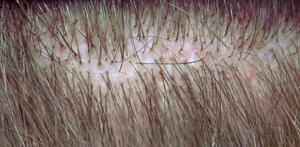 LINEAR EXCISION HAIR RESTORATION With this method, instead of using the ARTAS robot to obtain the follicles from your donor area, after local anesthesia so your scalp is 100% numbed, I remove a thin