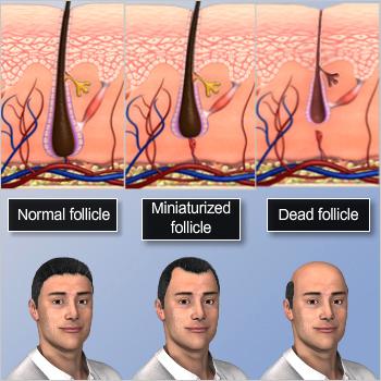 Follicle Miniaturization Typically, about 90% of hair follicles are actively growing new hair; however, with the onset of hair thinning, this percentage drops to 80% or less.