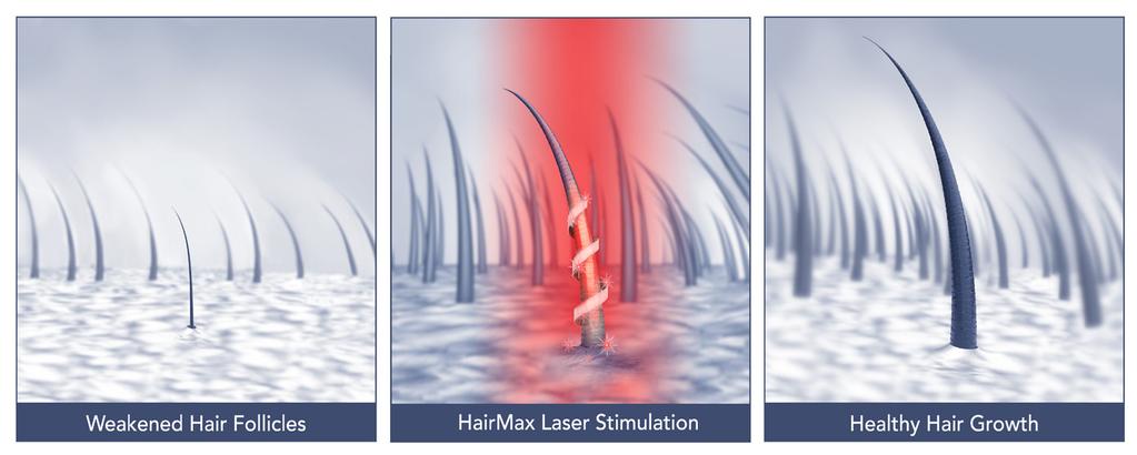 Laser Therapy for Hair Growth HOW LOW LEVEL LASER THERAPY WORKS Safe, easy and effective, low level lasers deliver light energy directly to the scalp through a process known as Photo Biostimulation.