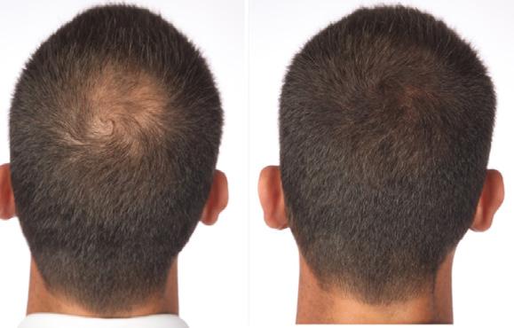 Camouflage Thinning Areas QUICK FIX FOR THICKER LOOKING HAIR Hair fibers are an excellent all natural way of improving the appearance of thinning or balding hair.