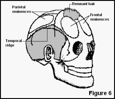 Skull expansion of these two frontal eminences (left and right) will cause hair loss at the front hairline.