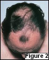 2 Female pattern baldness Up to 50% of women will experience AGA to some extent during their lives.