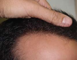 TREATING ALL TYPES OF HAIR LOSS - visit our websites FoundHair.com, WomensCenterForHairLoss.com, and EyebrowTransplantation.