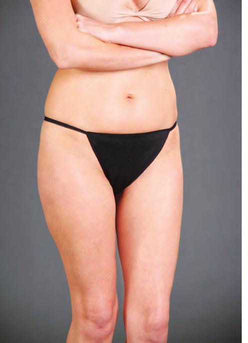 exposes hips and thighs without distorting body contour